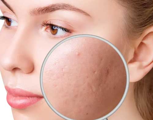 Acne Scars Treatment in Goregaon