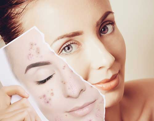 Acne Treatment in Goregaon