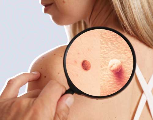 skin tags/growth treatment in Goregaon