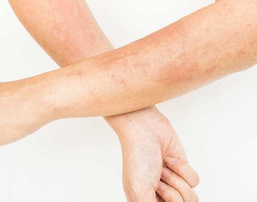 Eczema treatment in Goregaon