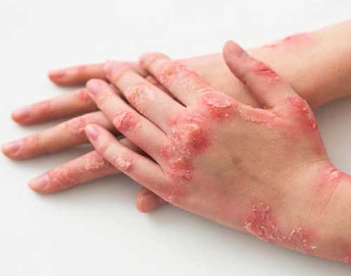 Psoriasis treatment in Goregaon