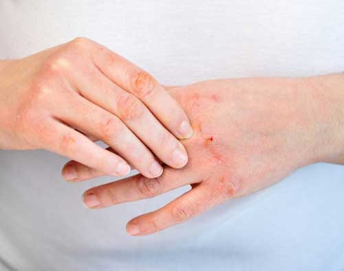 Atopic Dermatitis treatment in Goregaon