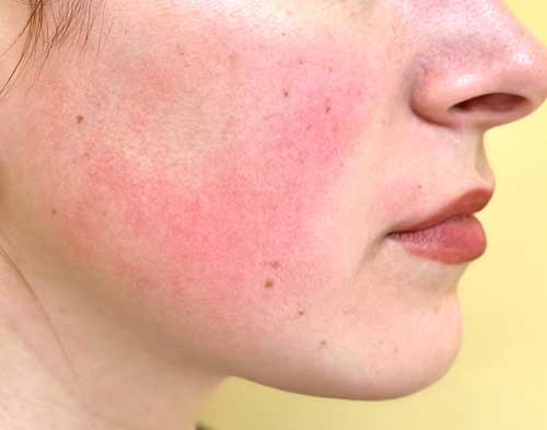 Rosacea treatment in Goregaon 