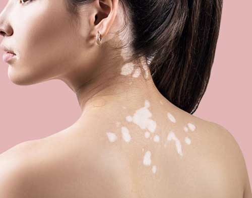 Vitiligo treatment in Goregaon 