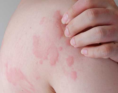 Urticaria/Hives treatment in Goregaon 