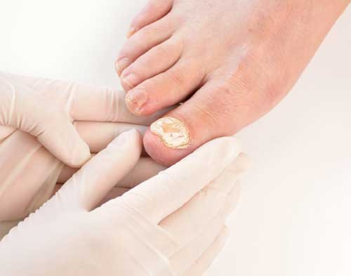 Nail Fungal treatment in Goregaon 