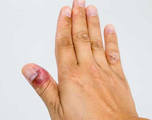 Nail Infection treatment in Goregaon 