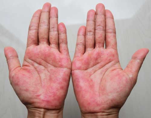 Hand & Foot Eczema treatment in Goregaon 