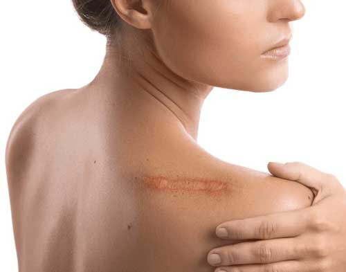 Scar treatment in Goregaon